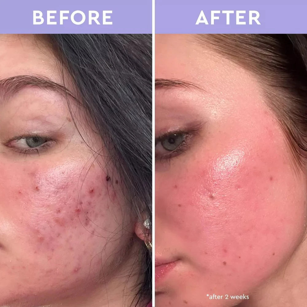 Spot A Spot Exfoliating Blemish Solution